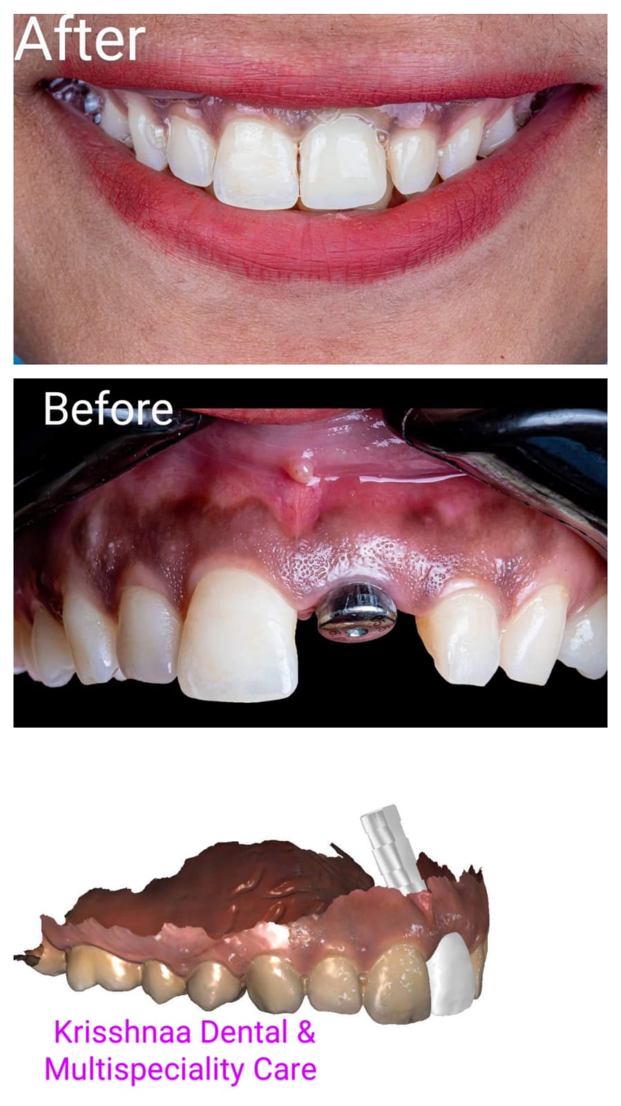 Some Interesting Facts about Dental Implants